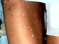 Ideopathic guttate hypomelanosis
