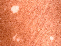 Ideopathic guttate hypomelanosis
