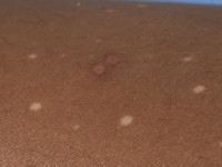 Ideopathic guttate hypomelanosis