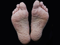 Maceratio cutis, verweekte huid