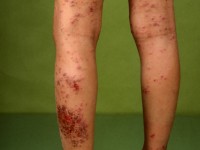 Impetiginisatie