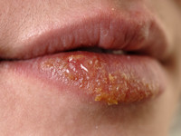 Honey yellow crusts in impetigo vulgaris