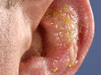 Honey yellow crusts in impetigo vulgaris