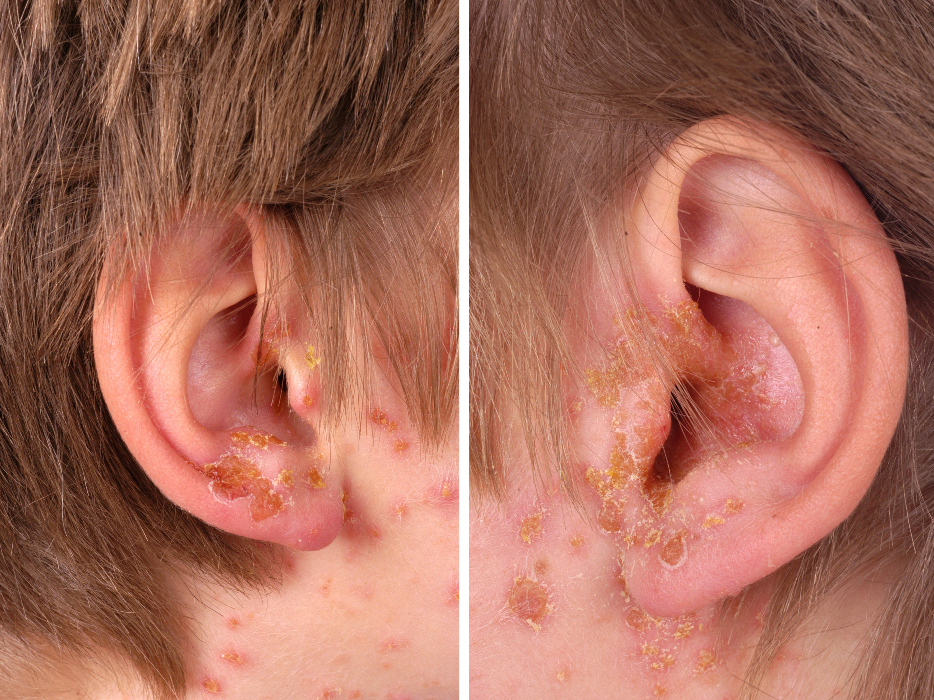Impetigo school Sores Staphylococcal Infection patienten Impetigo school Sores Staphylococcal Infection patienten