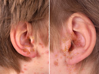 Honey yellow crusts in impetigo vulgaris