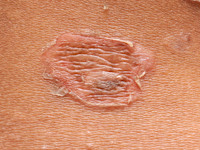 Honey yellow crusts in impetigo vulgaris