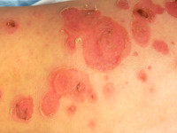 Impetigo vulgaris