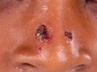 Impetigo vulgaris