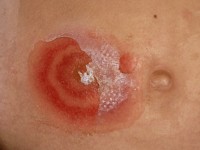 Impetigo bullosa