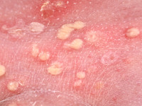 Impetigo bullosa