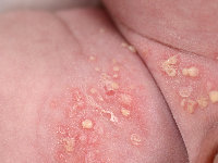 Impetigo bullosa