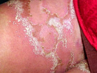 Impetigo herpetiformis