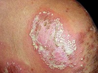 Impetigo herpetiformis