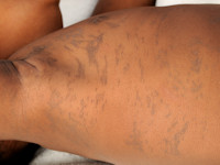 Incontinentia pigmenti