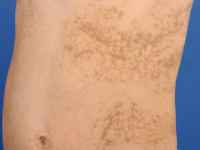 Incontinentia pigmenti