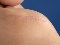 Incontinentia pigmenti