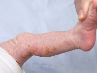 Incontinentia pigmenti