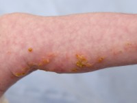 Incontinentia pigmenti