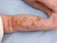 Incontinentia pigmenti