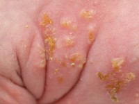 Incontinentia pigmenti