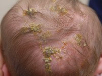 Incontinentia pigmenti