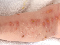 Incontinentia pigmenti