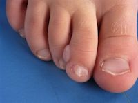 Acraal fibrokeratoom