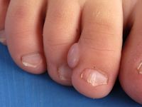 Acraal fibrokeratoom