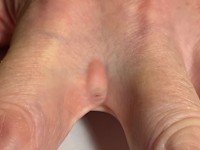 Interdigitale sinus pilonidalis