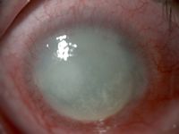 Keratitis interstitialis