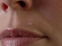 Inverted follicular keratosis