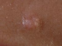 Inverted follicular keratosis