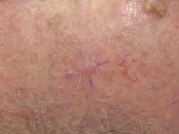 Inverted follicular keratosis