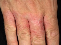 Irritant contact dermatitis