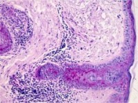 Histologie van lymphocytic infiltration of the skin (Morbus Jessner)