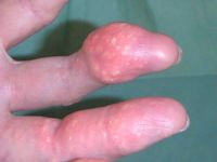 Gout, uric arthritis