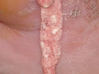 Jicht, arthritis urica