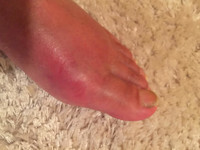 Gout, uric arthritis