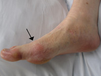 Gout, uric arthritis