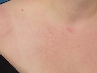 Juveniel elastoma (naevus elasticus)