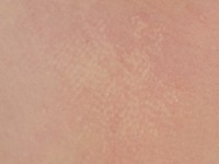 Juveniel elastoma (naevus elasticus)