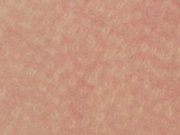 Juveniel elastoma (naevus elasticus)