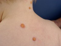 Juvenile xanthogranuloma