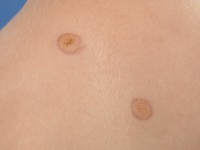 Juveniel xanthogranuloom