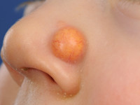 Juveniel xanthogranuloom