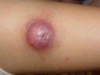 Juveniel xanthogranuloom