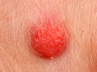 Juvenile xanthogranuloma