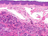 Juveniel xanthogranuloom