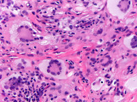 Juveniel xanthogranuloom