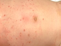 Juveniele myelomonocytaire leukemie